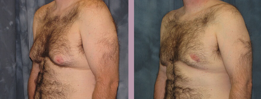 Case--1320 | Before and After Gynecomastia 2