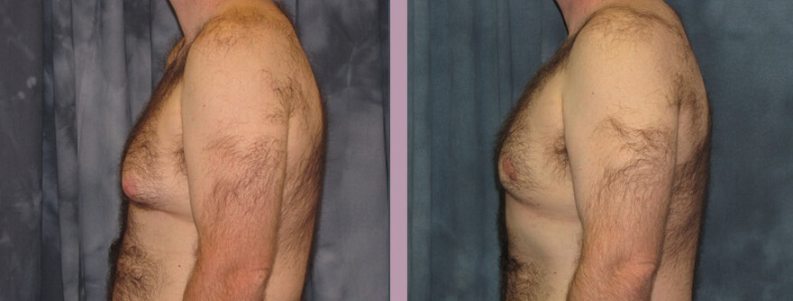 Case--1320 | Before and After Gynecomastia 3