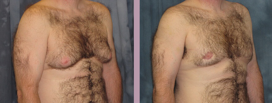 Case--1320 | Before and After Gynecomastia 4