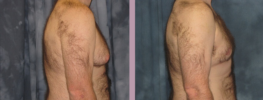 Case--1320 | Before and After Gynecomastia 5