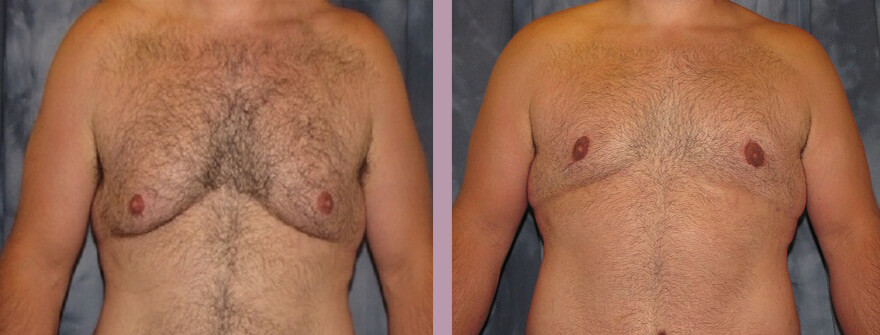 Case--1357 | Before and After Gynecomastia