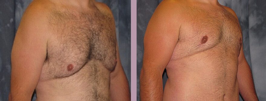 Case--1357 | Before and After Gynecomastia 2