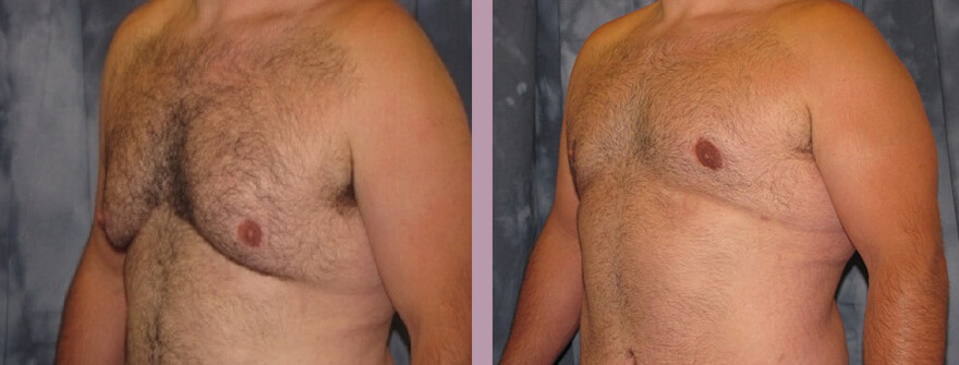 Case--1357 | Before and After Gynecomastia 3