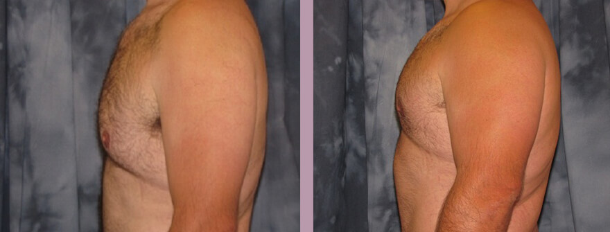 Case--1357 | Before and After Gynecomastia 4