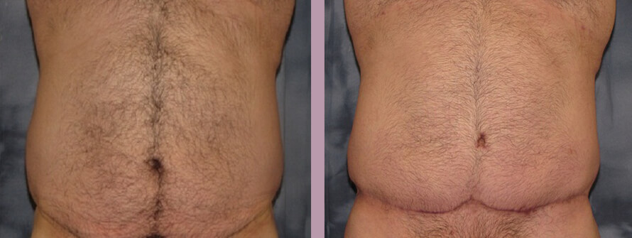Case--1357 | Before and After Gynecomastia 5