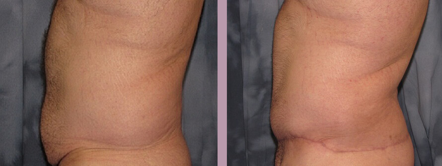 Case--1357 | Before and After Gynecomastia 6