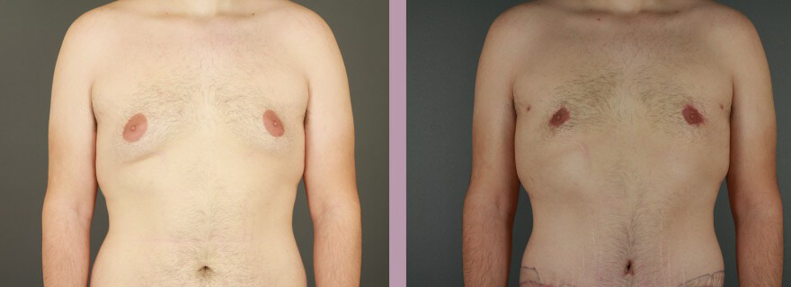 Case--16021 | Before and After Gynecomastia