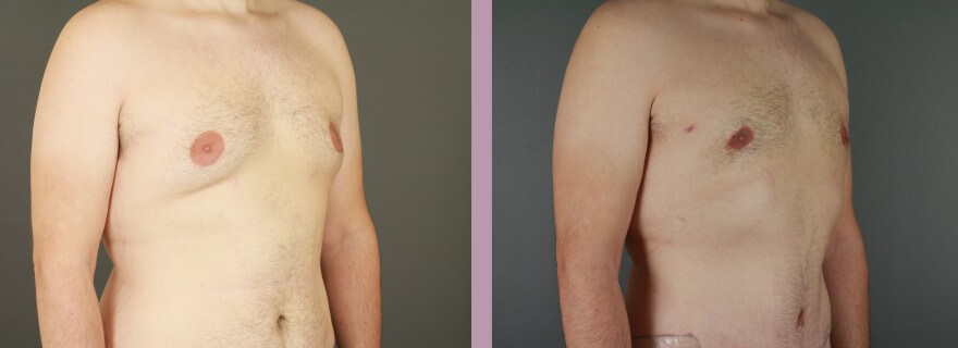 Case--16021 | Before and After Gynecomastia 2