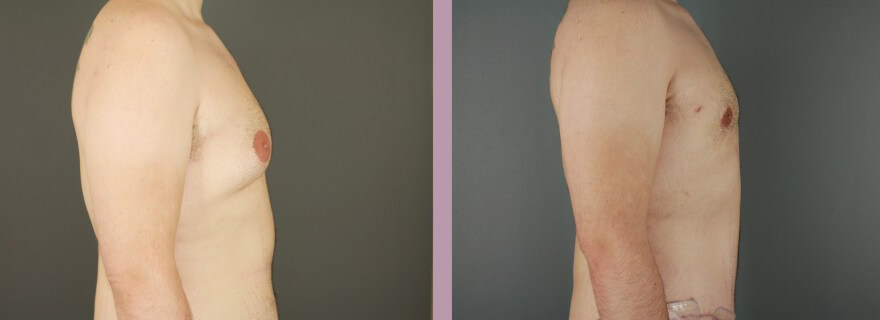 Case--16021 | Before and After Gynecomastia 3