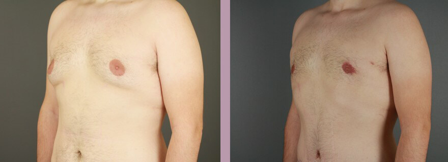 Case--16021 | Before and After Gynecomastia 4