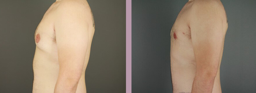 Case--16021 | Before and After Gynecomastia 5