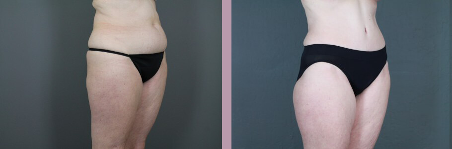 Case--14954 | Before and After Mommy Makeover 10