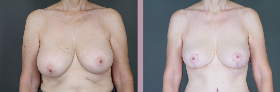 Case--14954 | Before and After Mommy Makeover