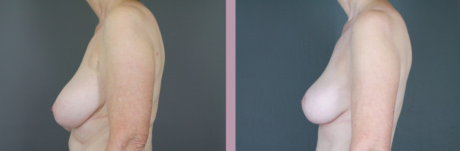 Case--14954 | Before and After Mommy Makeover 3