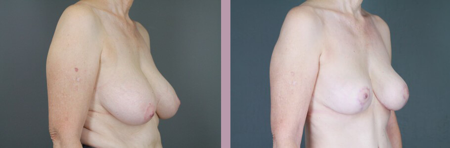 Case--14954 | Before and After Mommy Makeover 4