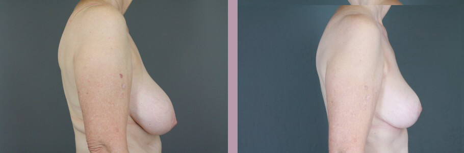 Case--14954 | Before and After Mommy Makeover 5