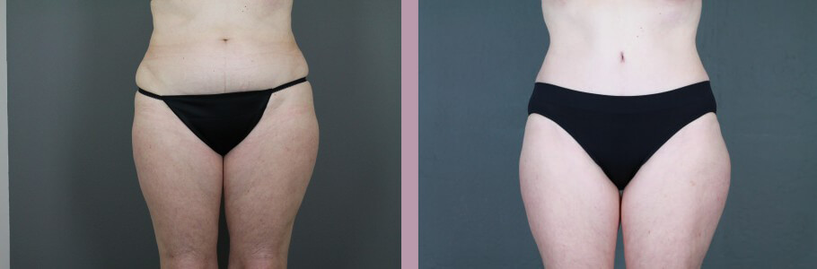 Case--14954 | Before and After Mommy Makeover 6