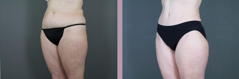 Case--14954 | Before and After Mommy Makeover 7