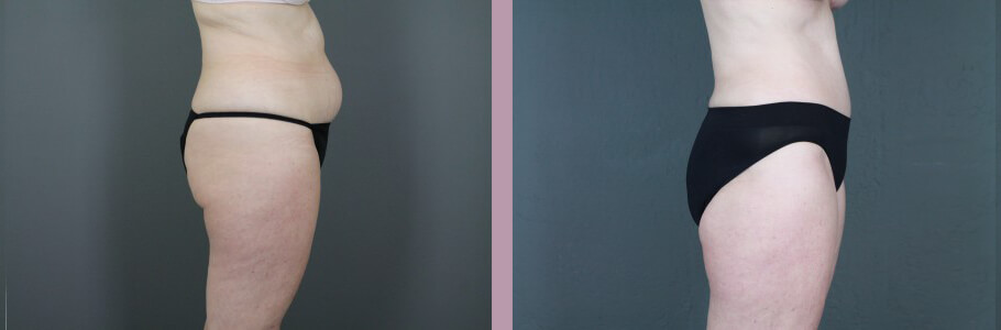 Case--14954 | Before and After Mommy Makeover 9