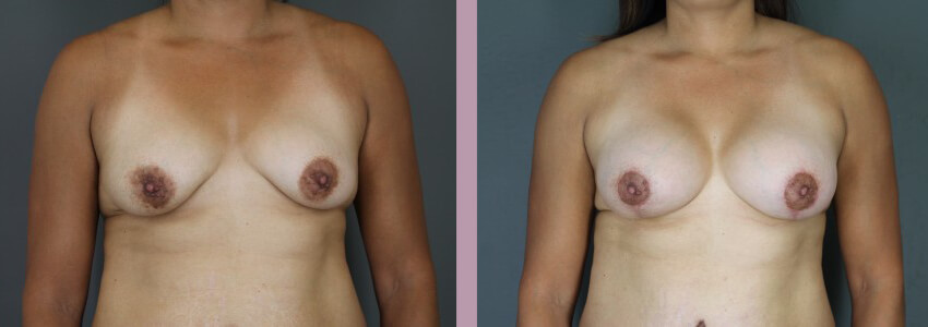 Case--15012 | Before and After Mommy Makeover