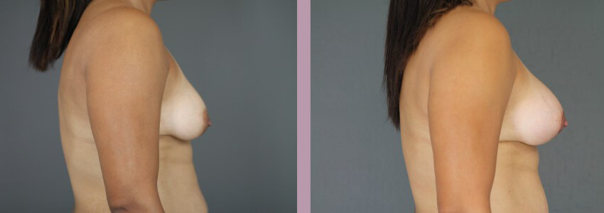 Case--15012 | Before and After Mommy Makeover 2