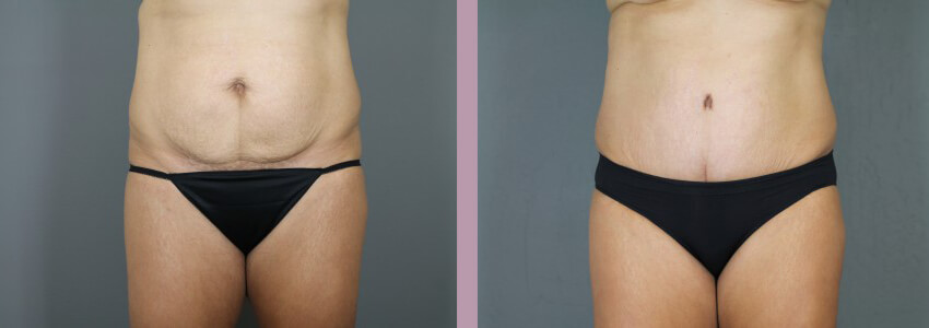 Case--15012 | Before and After Mommy Makeover 3