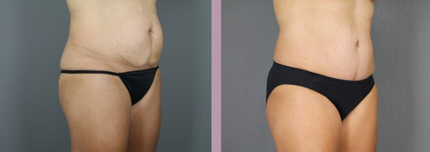 Case--15012 | Before and After Mommy Makeover 4