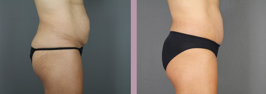 Case--15012 | Before and After Mommy Makeover 5