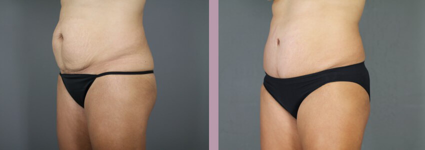 Case--15012 | Before and After Mommy Makeover 6