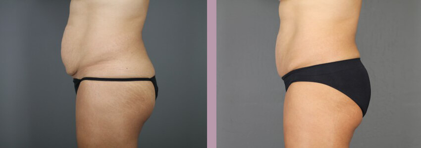 Case--15012 | Before and After Mommy Makeover 7