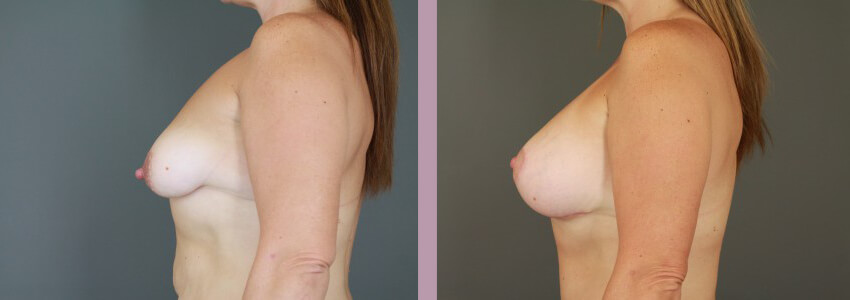 Case--15035 | Before and After Mommy Makeover 2