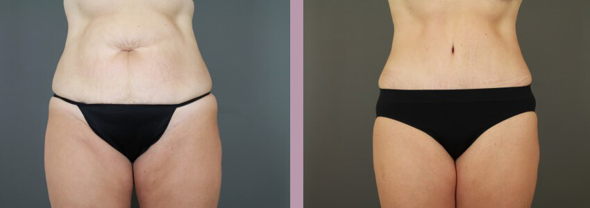 Case--15035 | Before and After Mommy Makeover 3