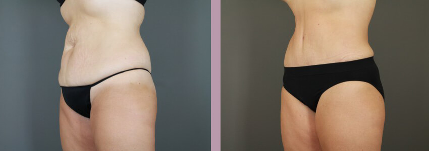 Case--15035 | Before and After Mommy Makeover 4