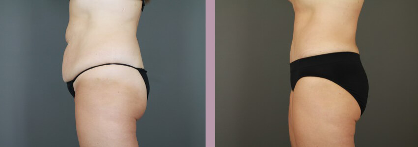 Case--15035 | Before and After Mommy Makeover 5