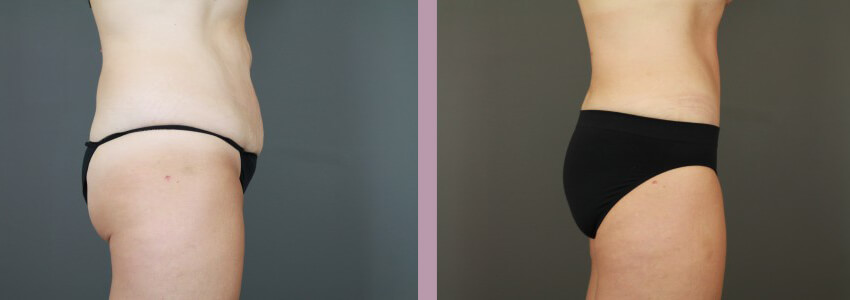 Case--15035 | Before and After Mommy Makeover 6