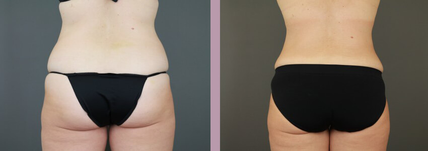 Case--15035 | Before and After Mommy Makeover 8