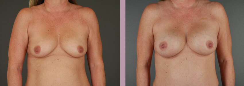 Case--15145 | Before and After Mommy Makeover