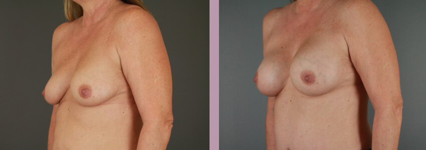 Case--15145 | Before and After Mommy Makeover 2