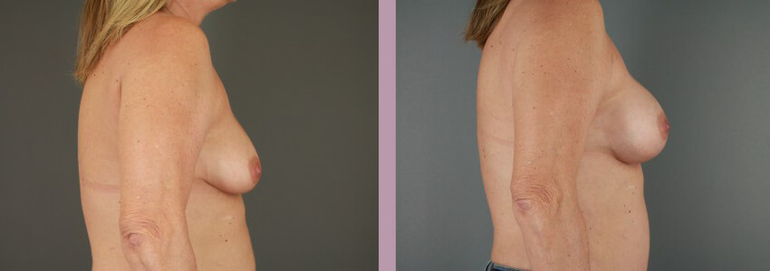 Case--15145 | Before and After Mommy Makeover 3