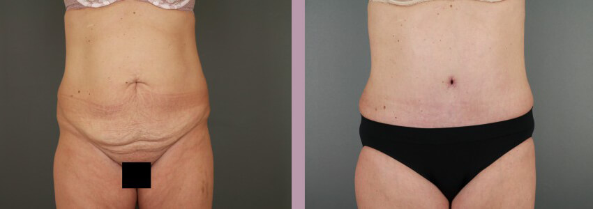 Case--15145 | Before and After Mommy Makeover 4