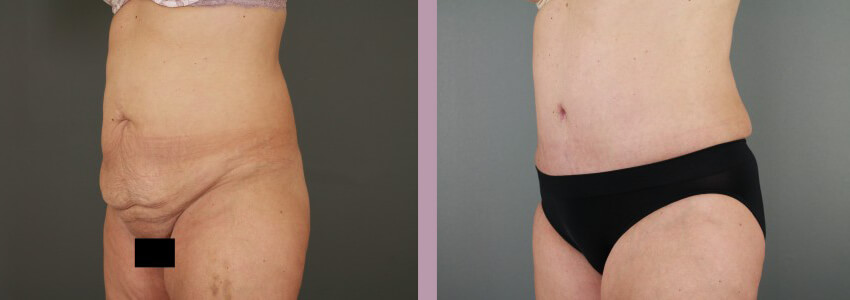 Case--15145 | Before and After Mommy Makeover 5