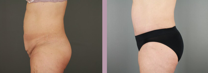 Case--15145 | Before and After Mommy Makeover 6