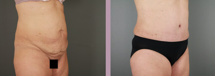 Case--15145 | Before and After Mommy Makeover 7