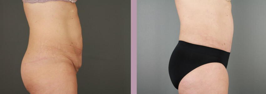 Case--15145 | Before and After Mommy Makeover 8