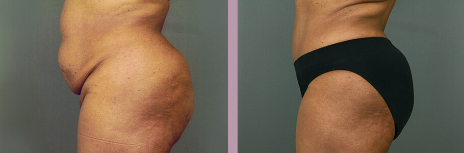 Case--15536 | Before and After Mommy Makeover 10