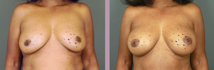 Case--15536 | Before and After Mommy Makeover