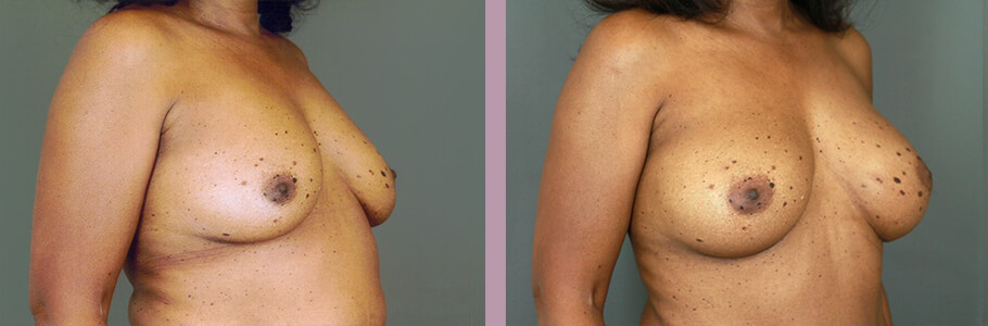 Case--15536 | Before and After Mommy Makeover 2