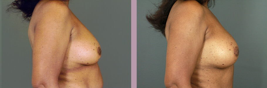 Case--15536 | Before and After Mommy Makeover 3