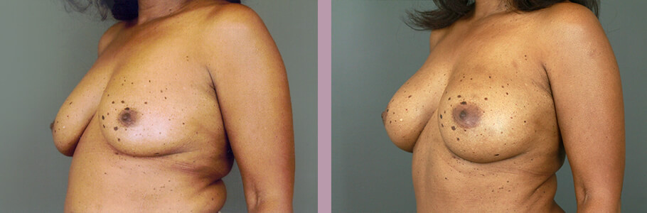 Case--15536 | Before and After Mommy Makeover 4