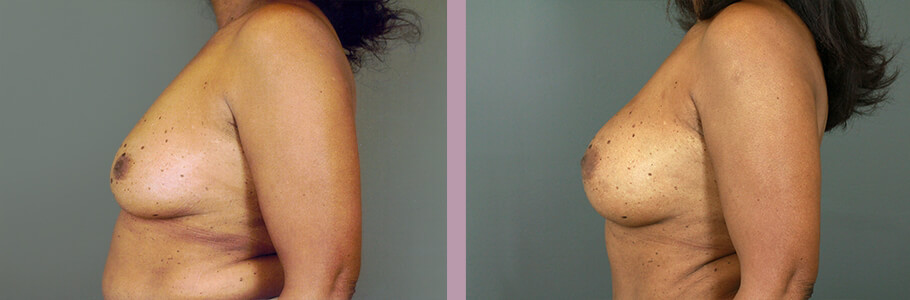 Case--15536 | Before and After Mommy Makeover 5